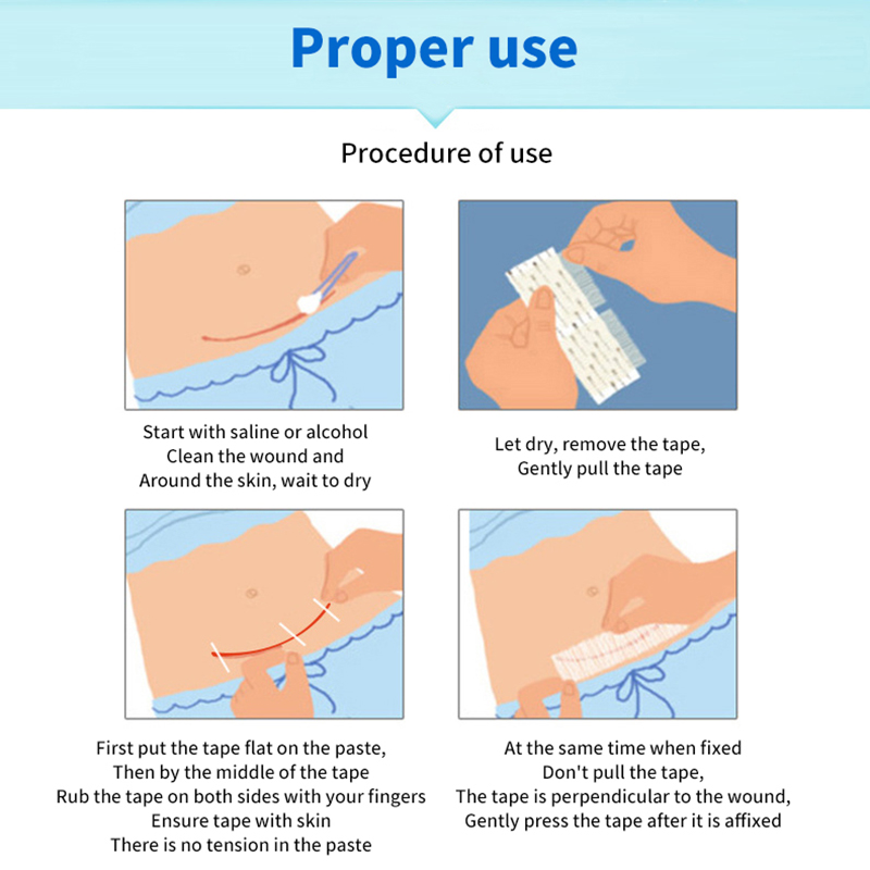 5 Strips Wound Skin Closure St - Medical Label ulasan dan harga